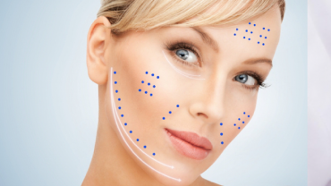 Intradermoterapia facial